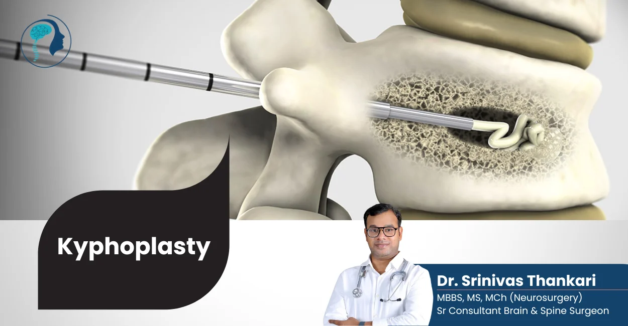 Kyphoplasty treatment in hyderabad - by dr srinivas